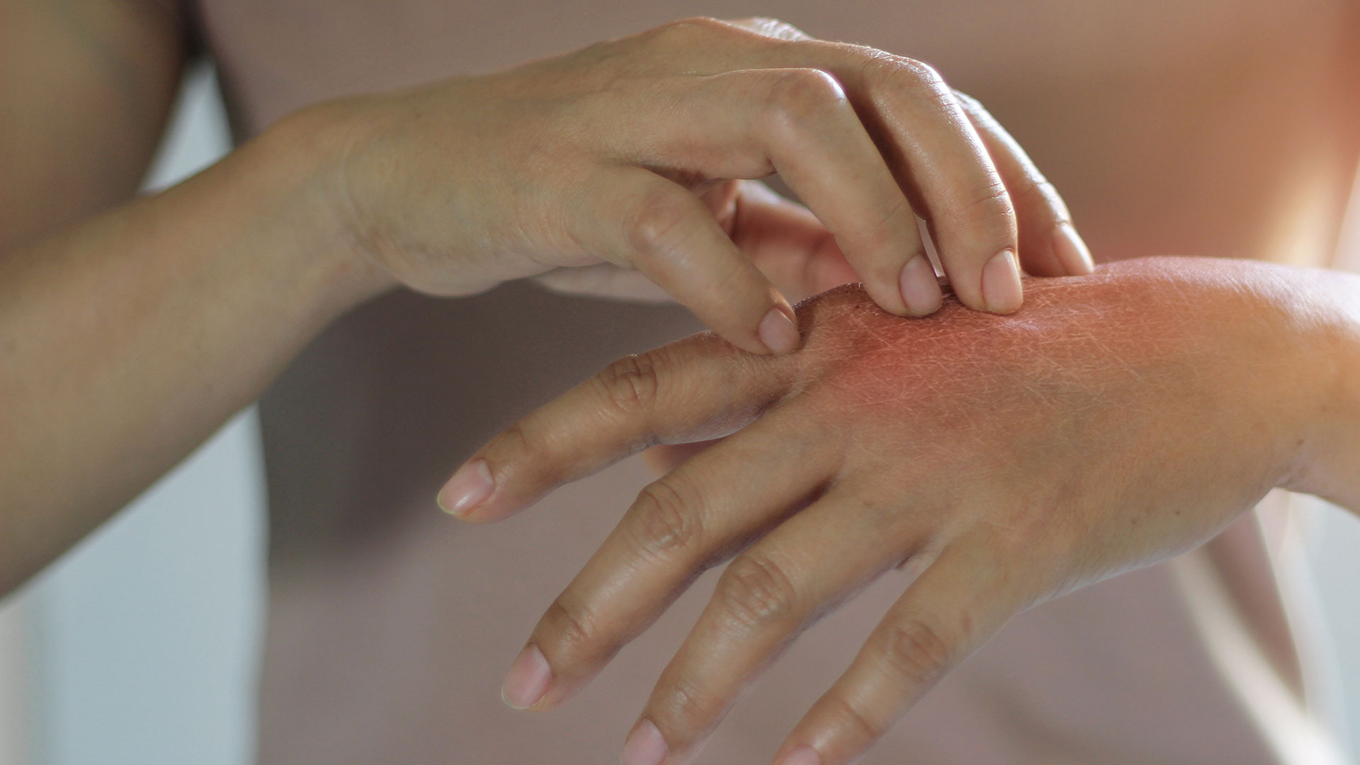 Mâini cu pielea deteriorată: cauze și | BIODERMA