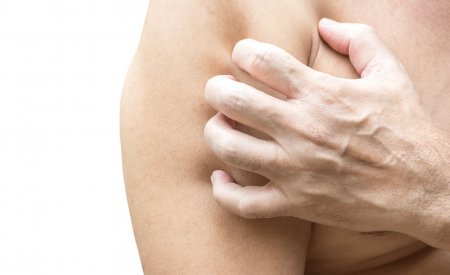 8 Remedii Naturiste Pentru Urticarie