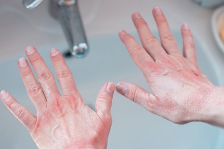 eczema mâinii