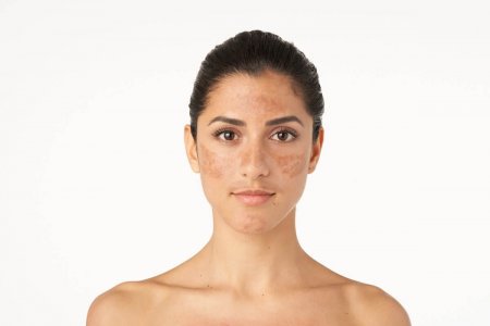 Melasma înseamnă o hiperpigmentate a pielii feței: