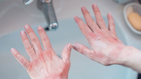 Eczema mâinii - Cum arată dermatita de contact iritativă?