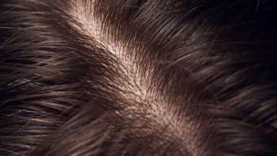 Tratament descuamare scalp