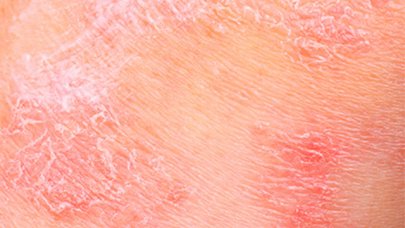 Pielea atopica , Dermatita atopica este o afectiune inflamatorie a pielii