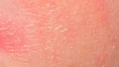 Mai Multe Informații Despre Psoriazis și Dermatita Seboreică Bioderma