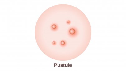 Pustule leziuni inflamate