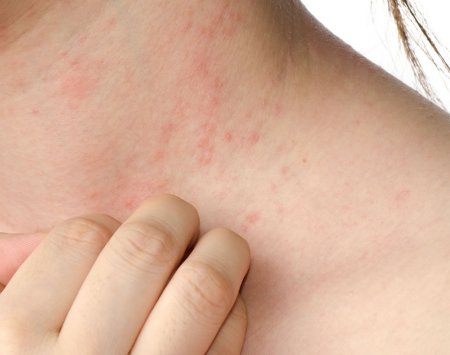 Eczemele pe gat - Care sunt cauzele dermatitei de contact alergice?