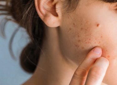 Tip de acnee - nodulara Leziuni ale pielii