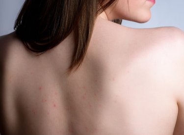 Tip de acnee - Pete rosii abcese inflamatorie