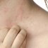 Scratching - Eczema - piele aspră și rugoasă (plăci scuamoase), iritație ușoară